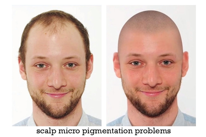 scalp micro pigmentation problems.jpg