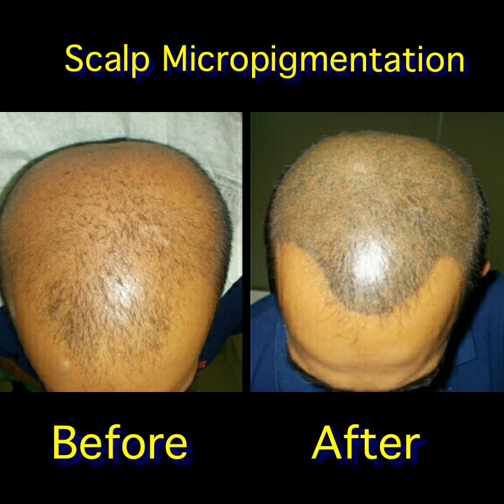 scalp-micropigmentationnew
